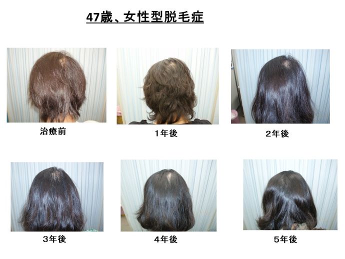 円形脱毛症　病院
